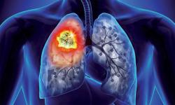 Rencontre scientifique autour du cancer du poumon